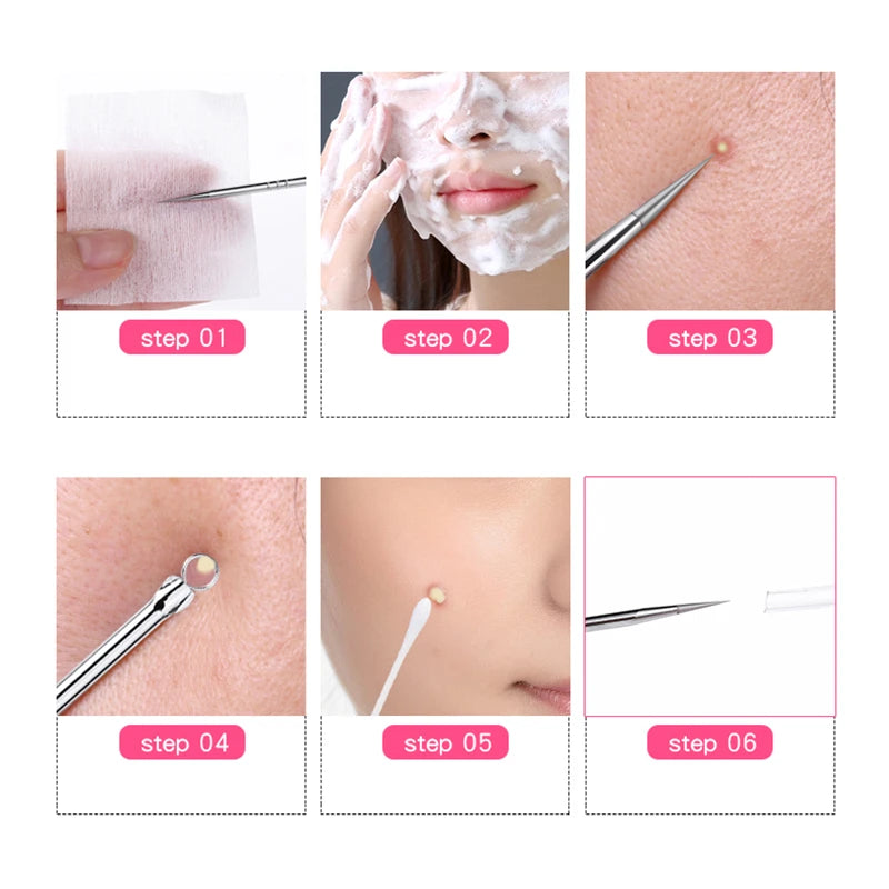 Blackhead & Acne Extractor Tool