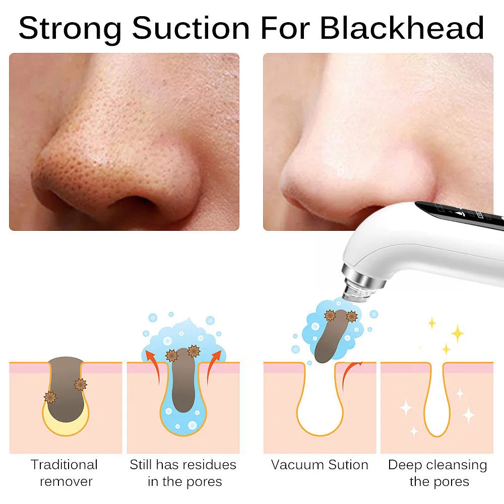 USB Rechargeable Blackhead Remover Vacuum