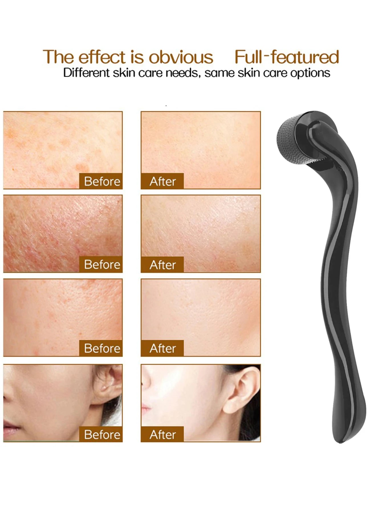 540 Microneedle Roller for Acne Scars