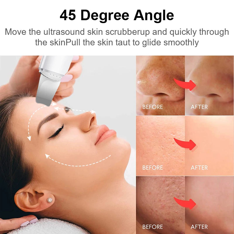 Facial Blackhead Remover