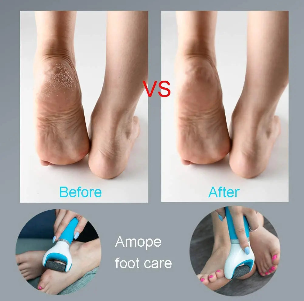 Electric Foot File - Remove Callouses