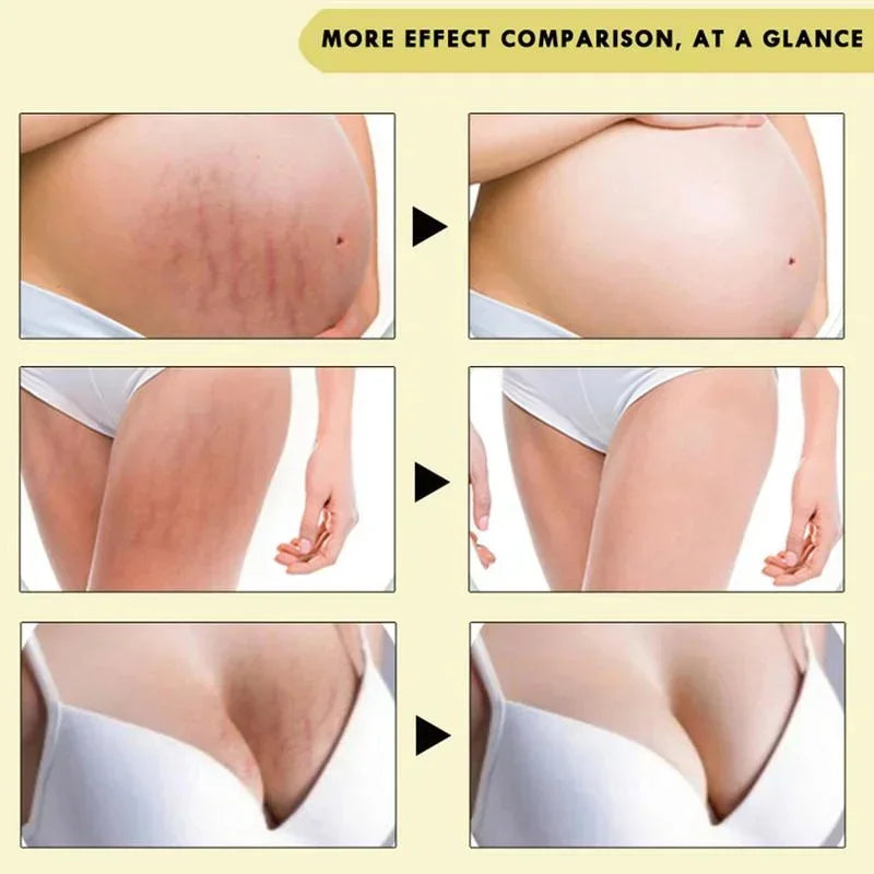 Advanced Stretch Mark Removal Oil