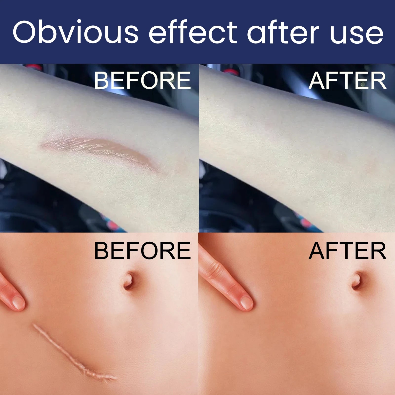 Advanced Silicone Scar Gel