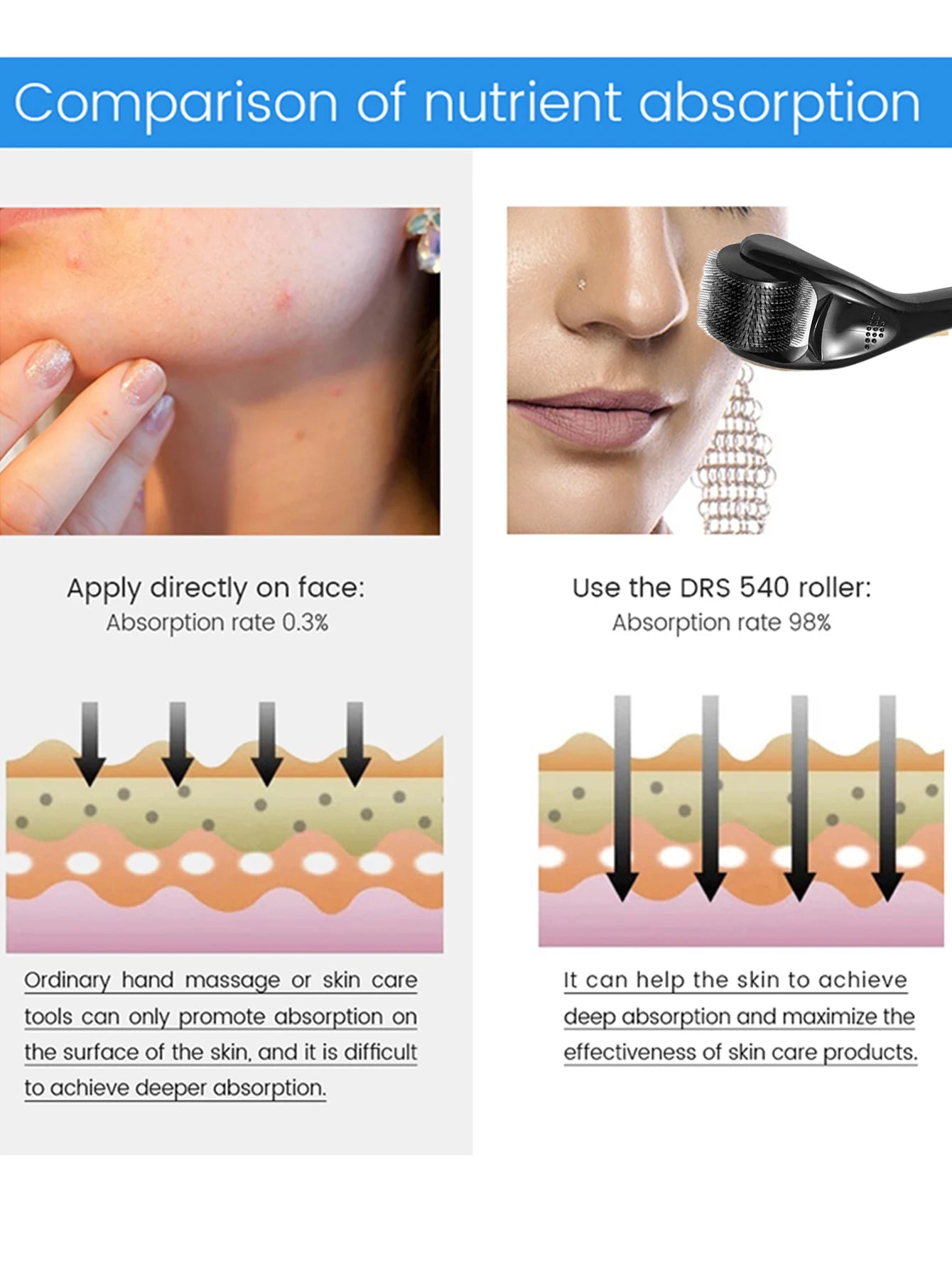 540 Microneedle Roller for Acne Scars