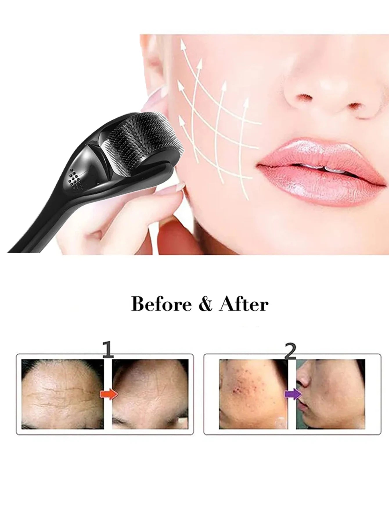 540 Microneedle Roller for Acne Scars