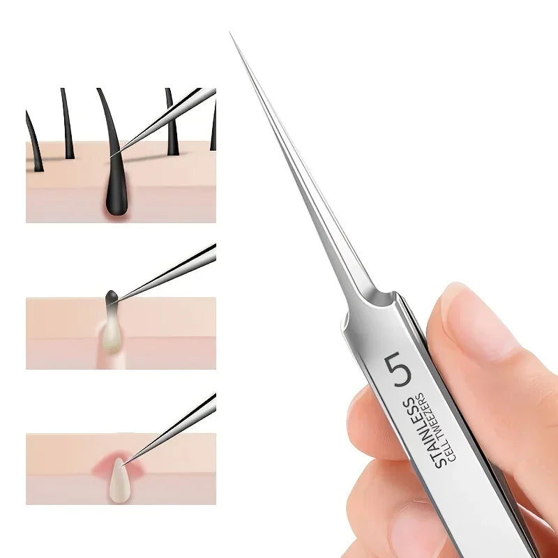 5 Blackhead Tweezers for Acne Removal Tool