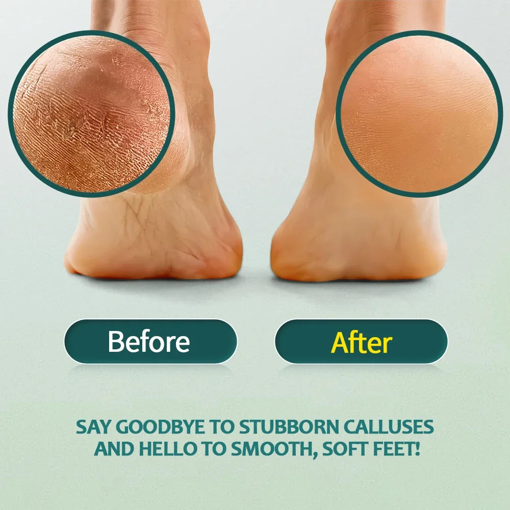 Callus Softener Gel and Foot File Set