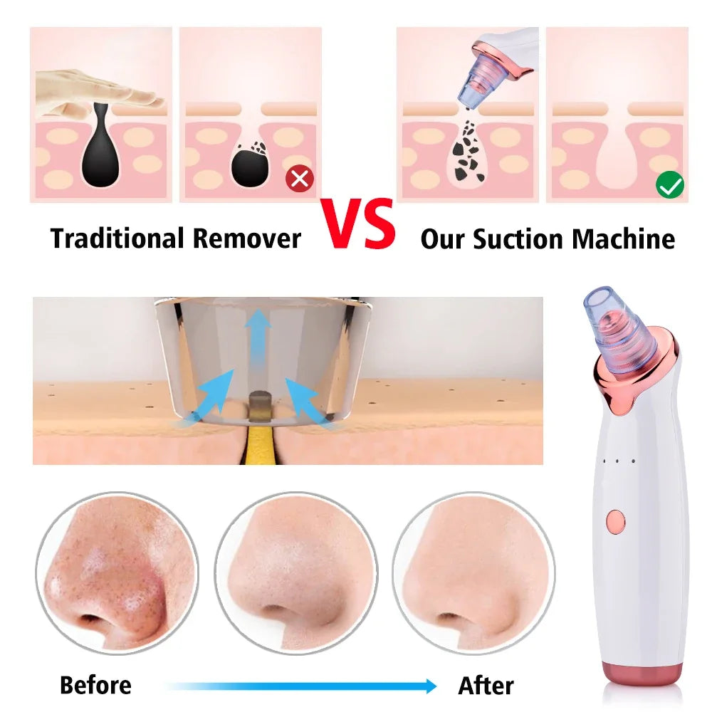USB Rechargeable Blackhead Vacuum Remover