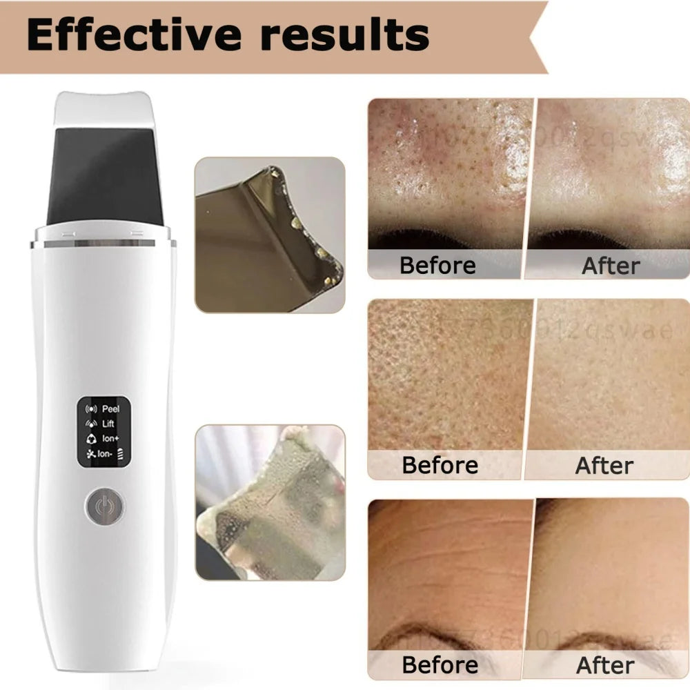 Ultrasonic Facial Skin Scrubber